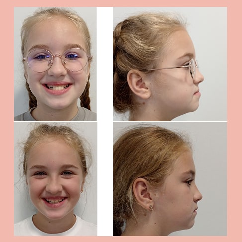 Екатерина, 10 лет. Неправильное переднее положение нижней челюсти, нижние зубы во фронтальной области перекрывают верхние, что сказывается на профиле девочки.