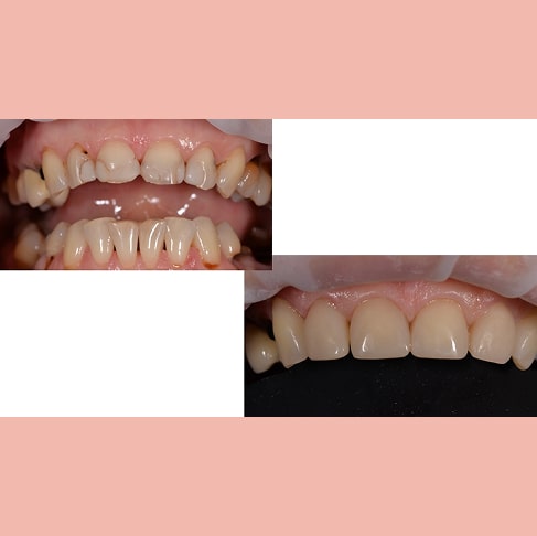 Реставрация передних 6 постоянных зубов