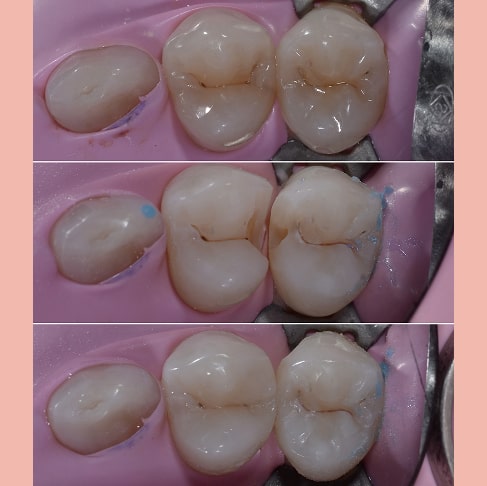 Лікування контактного карієсу в постійних зубах