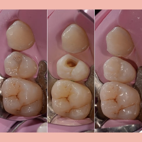 Лечение глубокого кариеса постоянного зуба