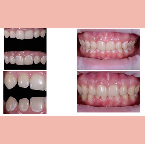 Лечение постоянных зубов с помощью системы «Icon» у подростка