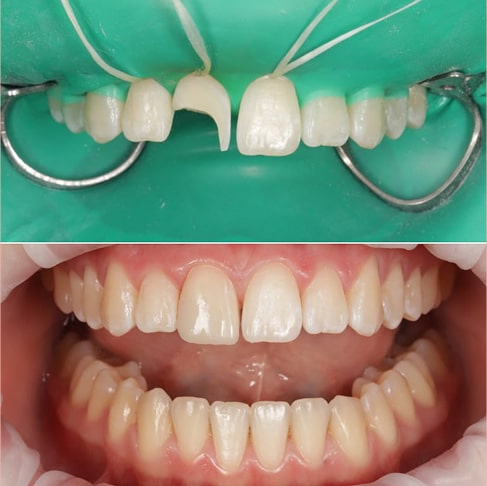 Реставрация переднего постоянного зуба после эндодонтического лечения у подростка