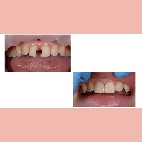 Лечение кариеса между передними постоянными зубами, реставрация.