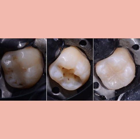 Лечение вторичного кариеса в постоянном зубе, замена пломбы.
