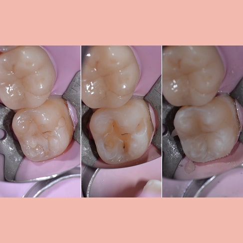 Лікування вторинного карієсу в постійному зубі, заміна пломби.