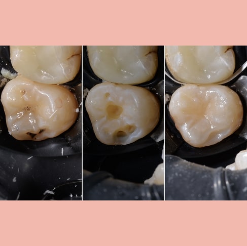 Лікування карієсу в постійному зубі.