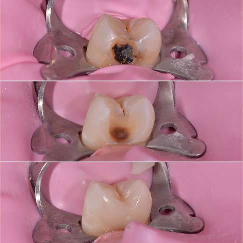 Лікування глибокого карієсу в постійному зубі